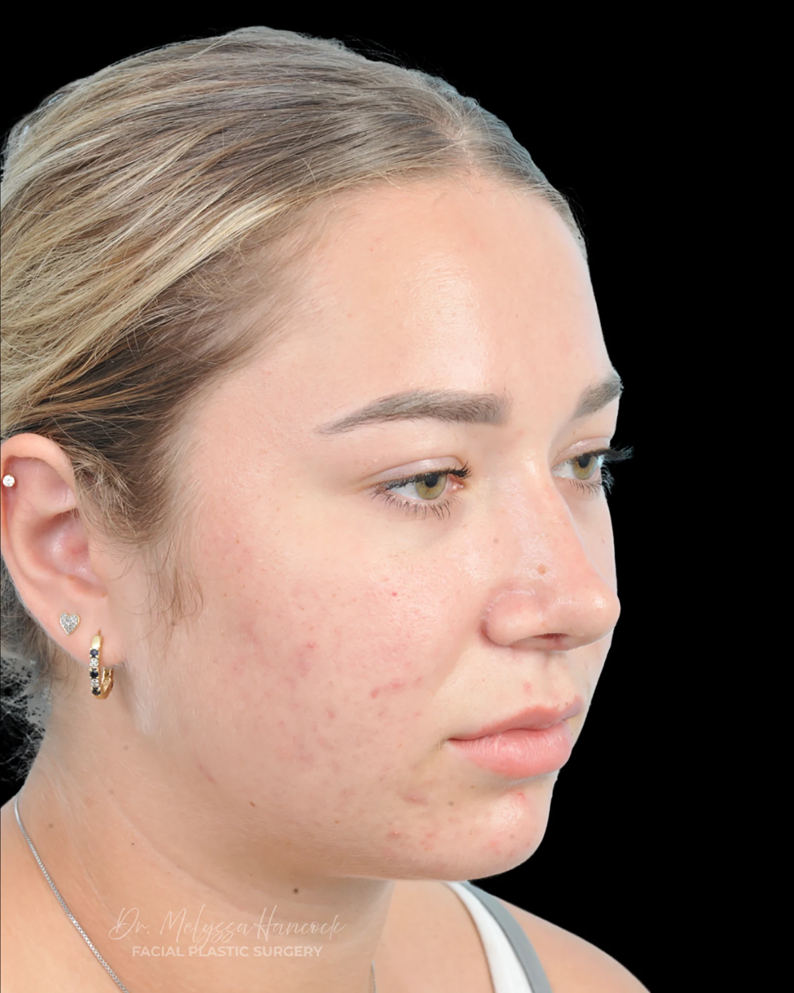 Photo of the patient’s after the Rhinoplasty Patient 15