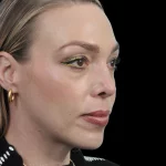 Thumbnail photo of the patient’s after the Rhinoplasty Patient 20