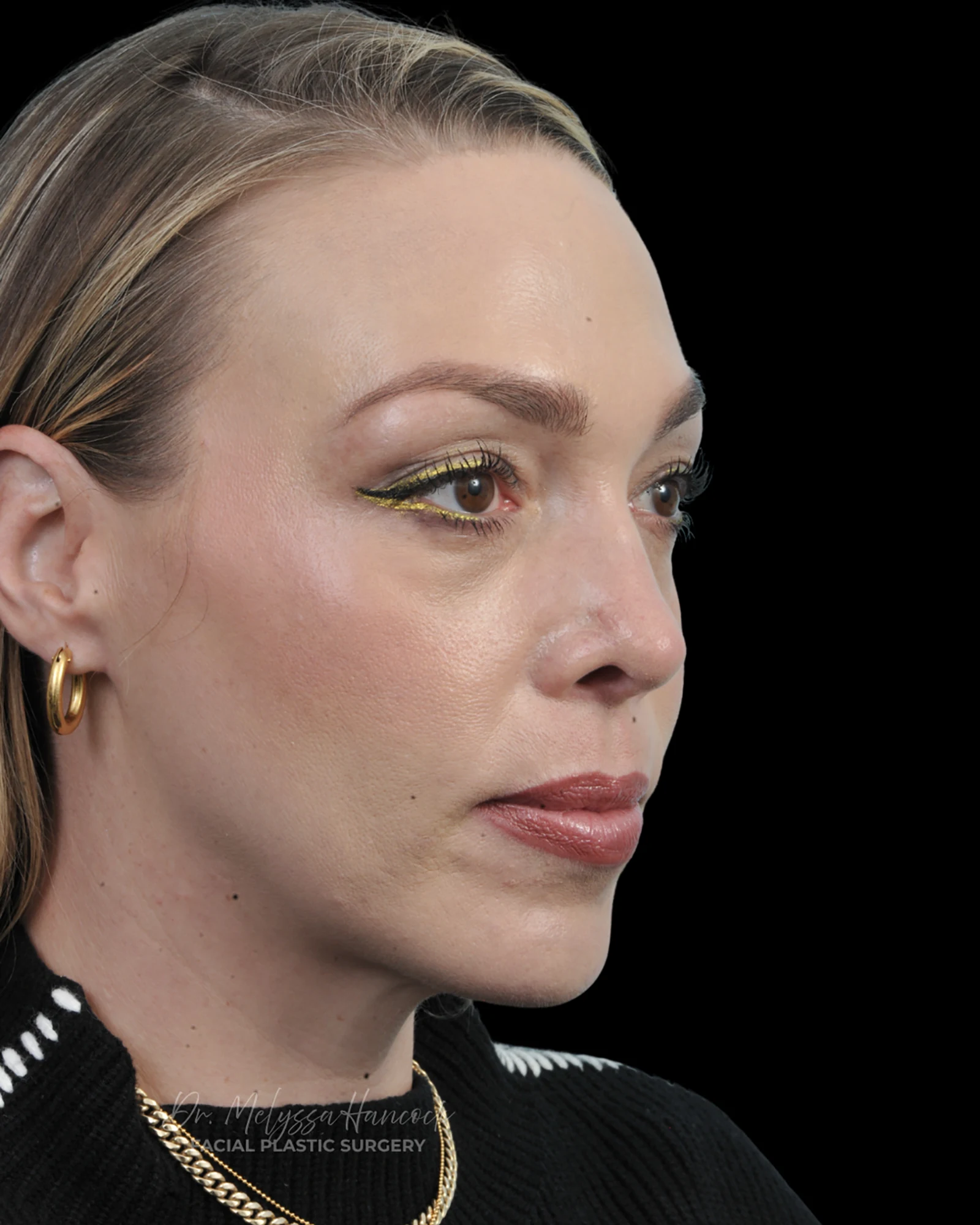 Photo of the patient’s after the Rhinoplasty Patient 20