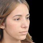 Thumbnail photo of the patient’s after the Rhinoplasty Patient 26