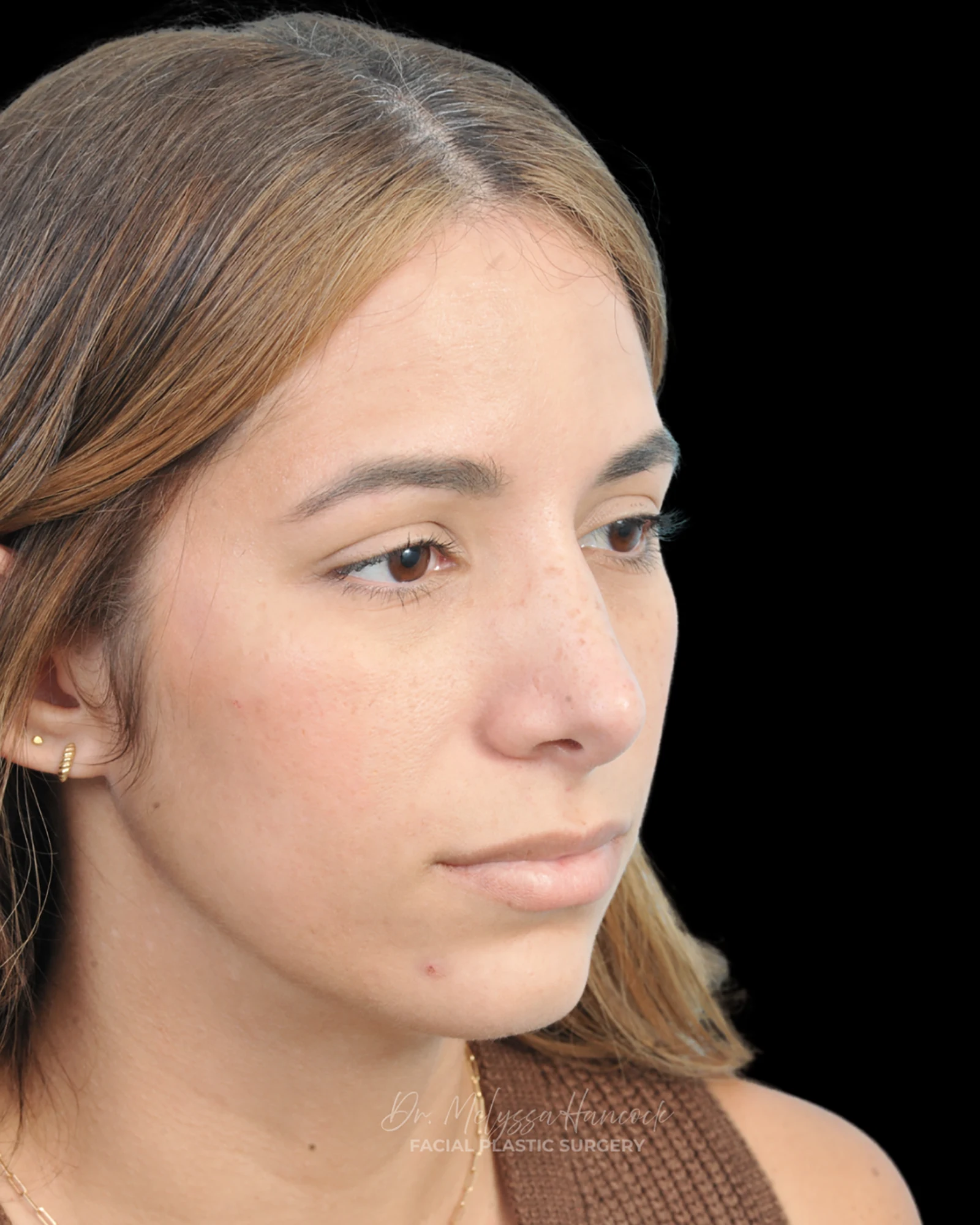 Photo of the patient’s after the Rhinoplasty Patient 26