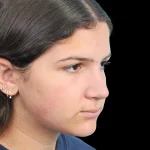 Thumbnail photo of the patient’s after the Rhinoplasty Patient 28