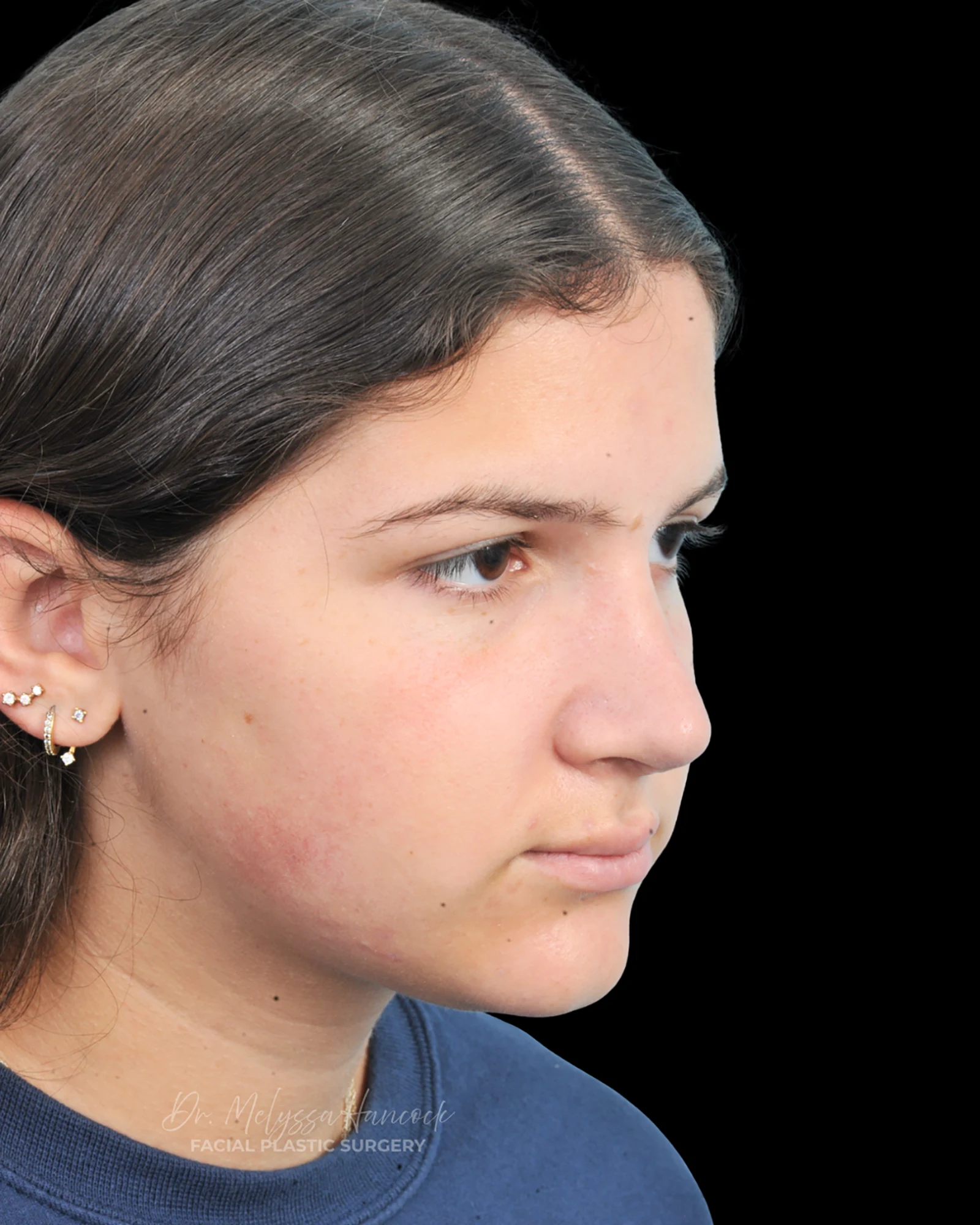 Photo of the patient’s after the Rhinoplasty Patient 28