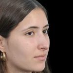 Thumbnail photo of the patient’s after the Rhinoplasty Patient 29