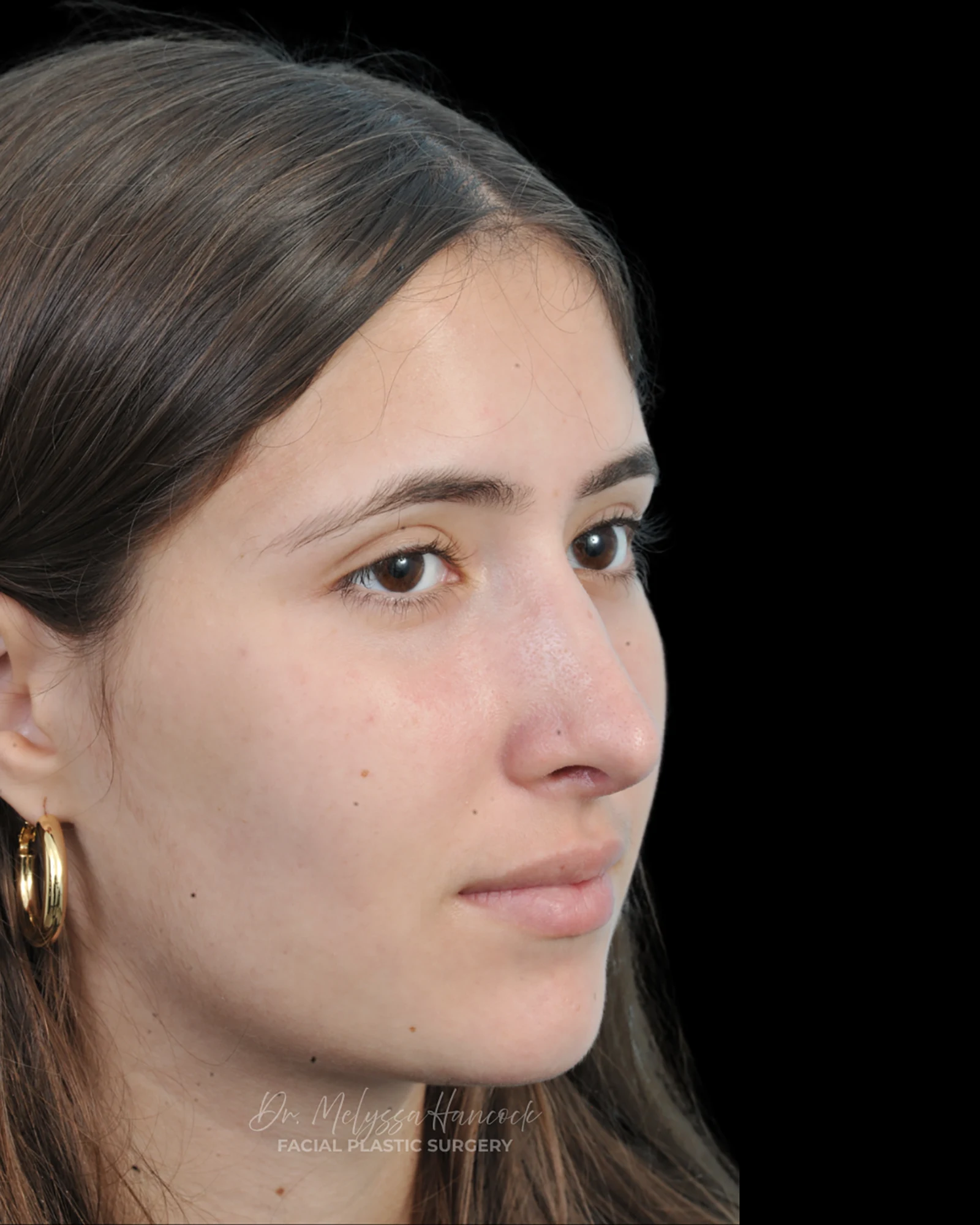 Photo of the patient’s after the Rhinoplasty Patient 29