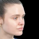Thumbnail photo of the patient’s after the Rhinoplasty Patient 30