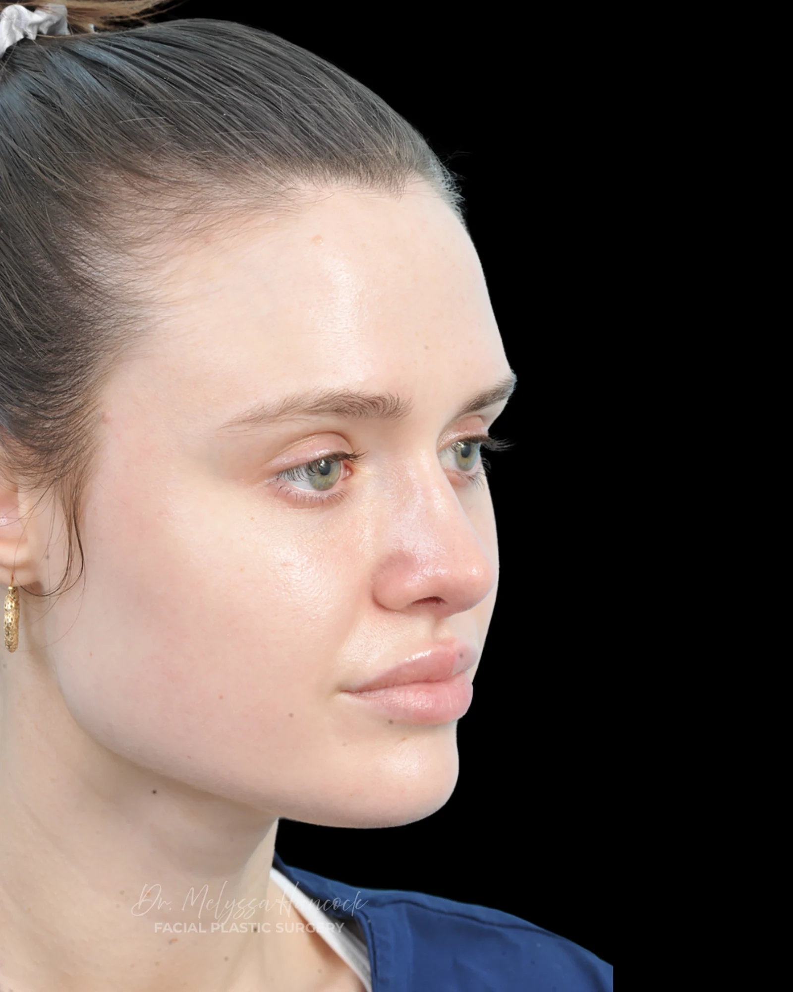 Photo of the patient’s after the Rhinoplasty Patient 30