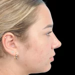 Thumbnail photo of the patient’s after the Rhinoplasty Patient 15