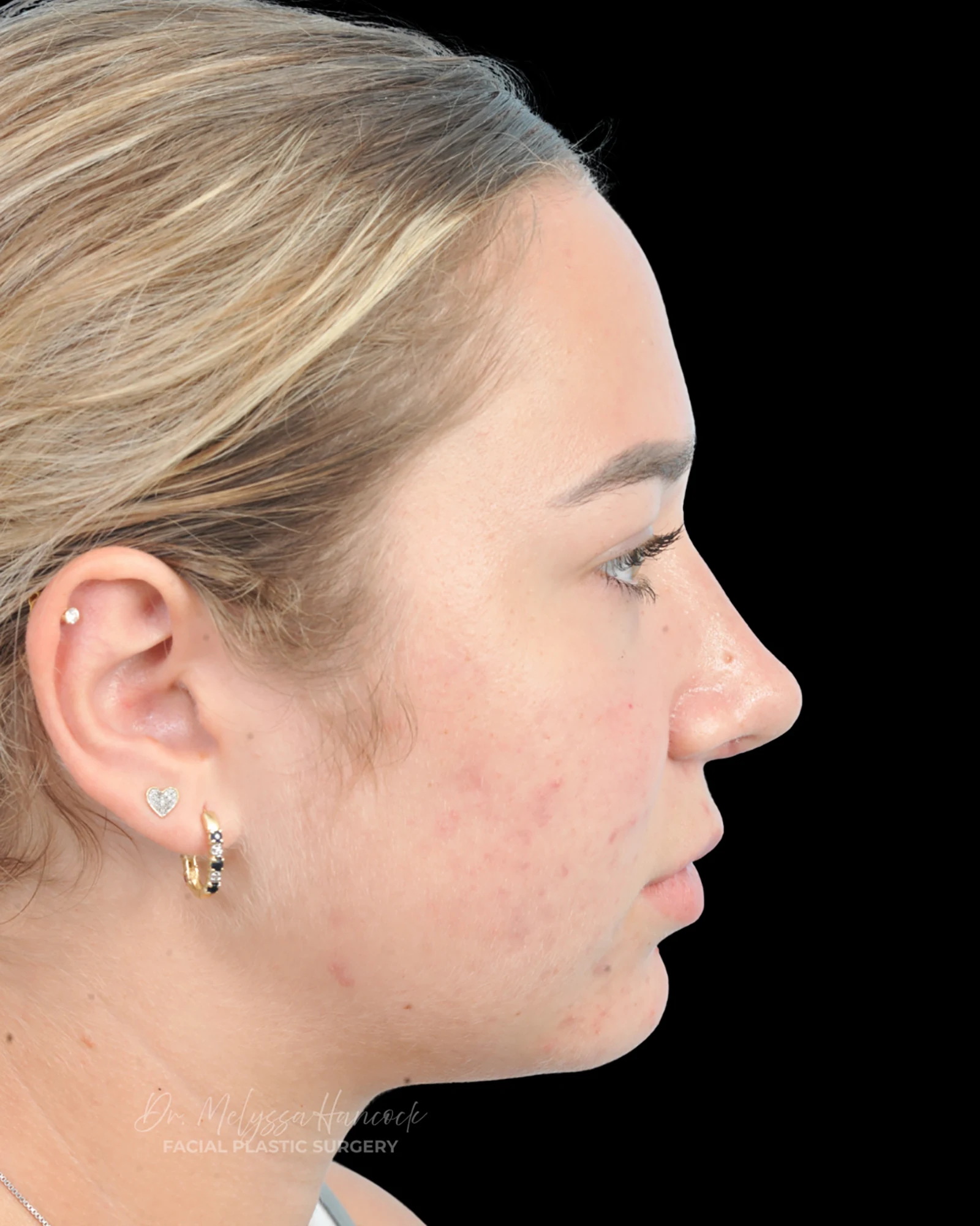 Photo of the patient’s after the Rhinoplasty Patient 15