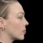 Thumbnail photo of the patient’s after the Rhinoplasty Patient 20