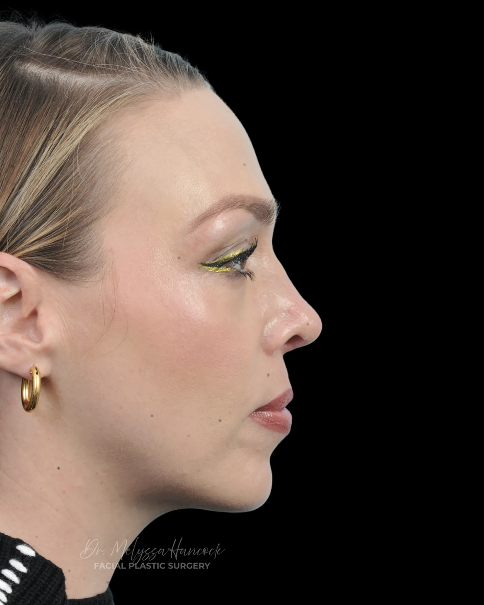 Photo of the patient’s after the Rhinoplasty Patient 20