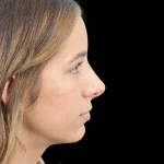 Thumbnail photo of the patient’s after the Rhinoplasty Patient 26