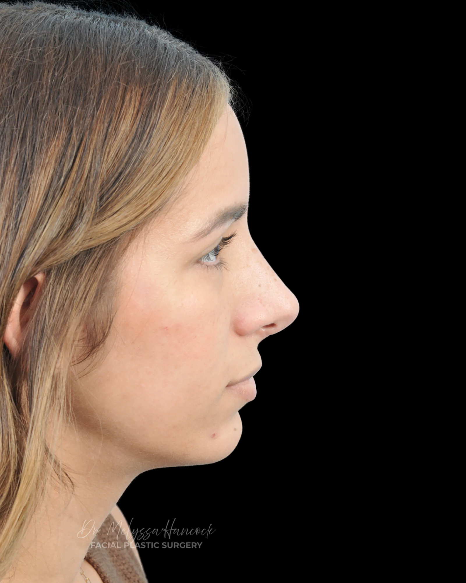 Photo of the patient’s after the Rhinoplasty Patient 26