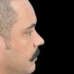 Thumbnail photo of the patient’s after the Rhinoplasty Patient 27