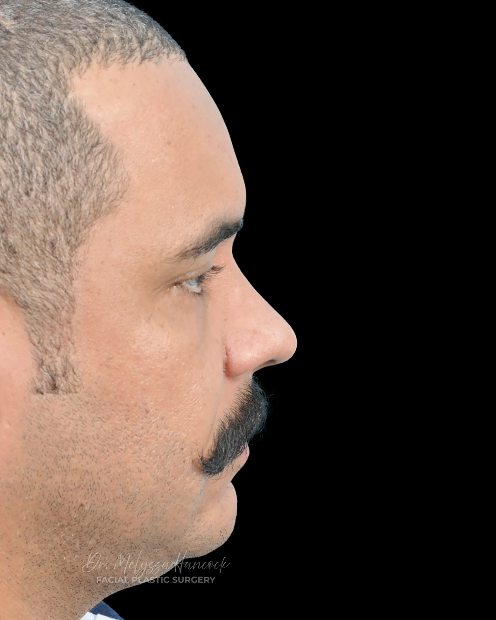 Photo of the patient’s after the Rhinoplasty Patient 27