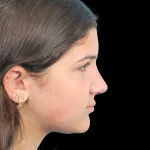 Thumbnail photo of the patient’s after the Rhinoplasty Patient 28