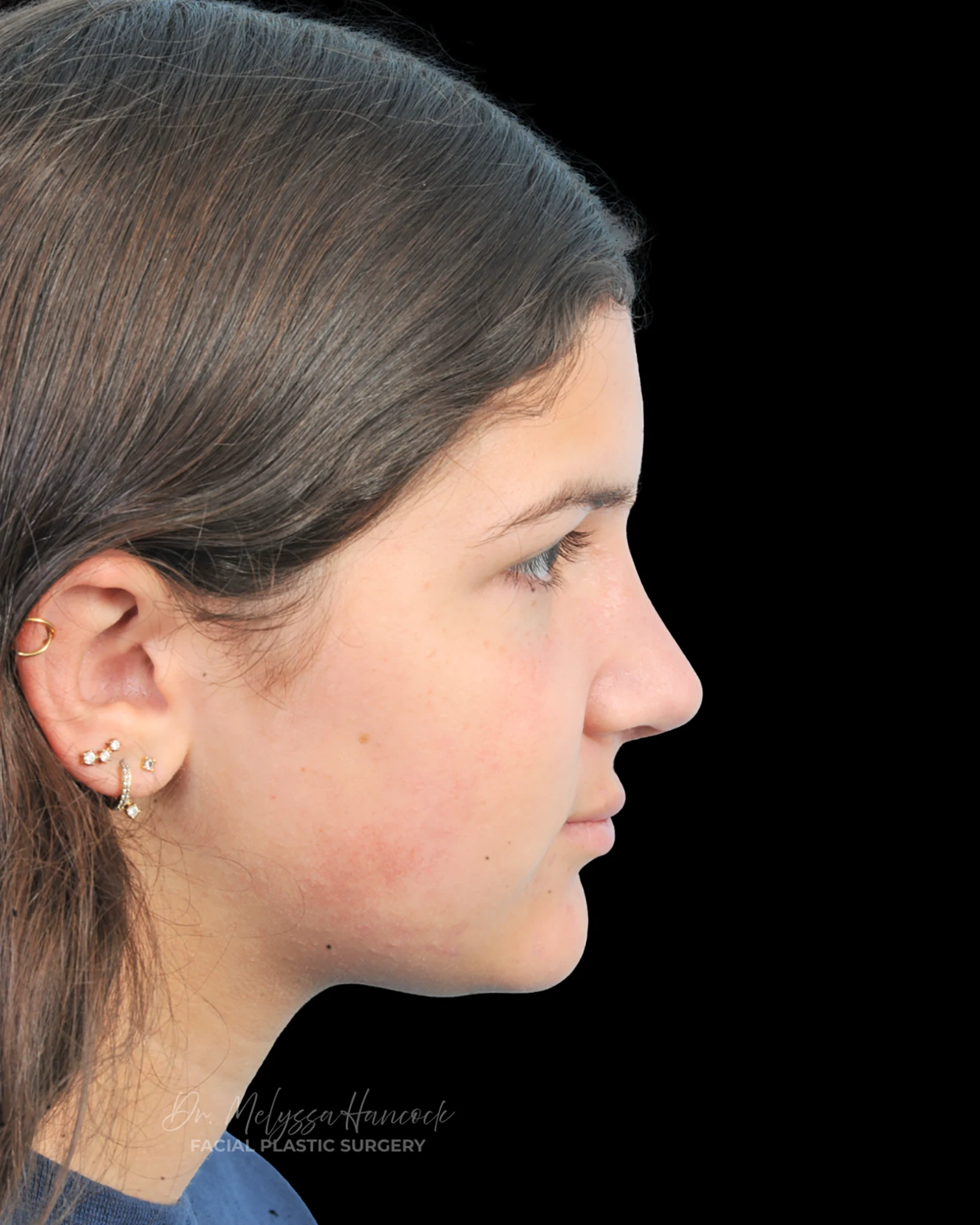 Photo of the patient’s after the Rhinoplasty Patient 28