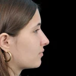 Thumbnail photo of the patient’s after the Rhinoplasty Patient 29