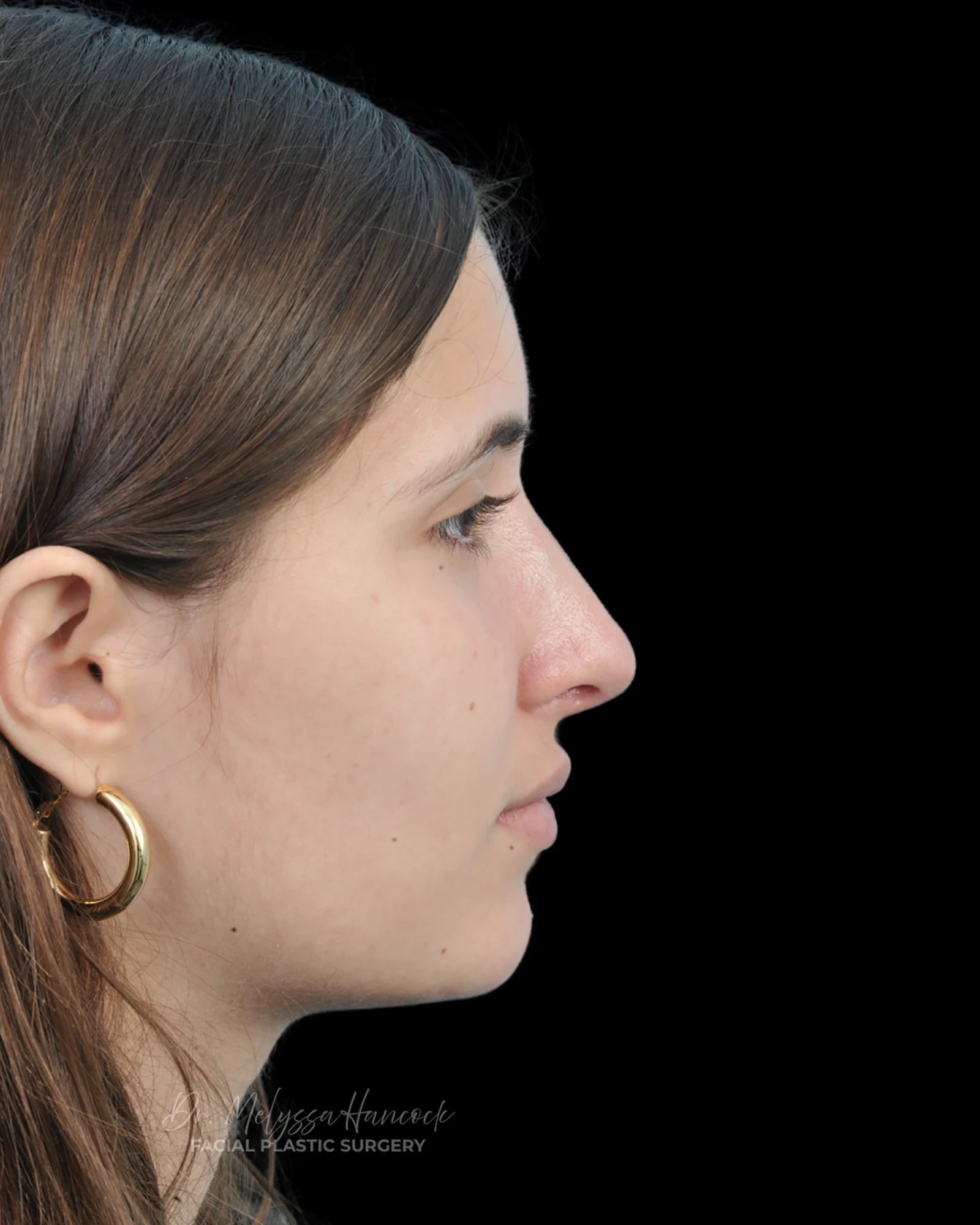 Photo of the patient’s after the Rhinoplasty Patient 29