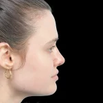 Thumbnail photo of the patient’s after the Rhinoplasty Patient 30