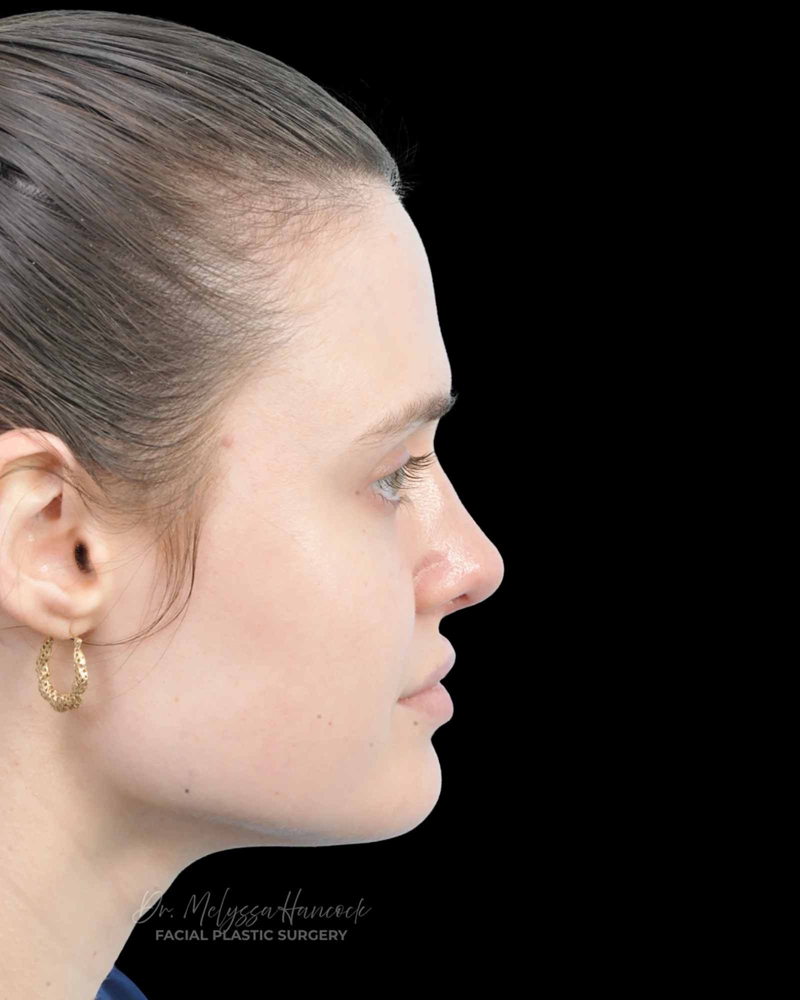 Photo of the patient’s after the Rhinoplasty Patient 30