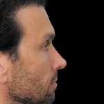 Thumbnail photo of the patient’s after the Rhinoplasty Patient 31