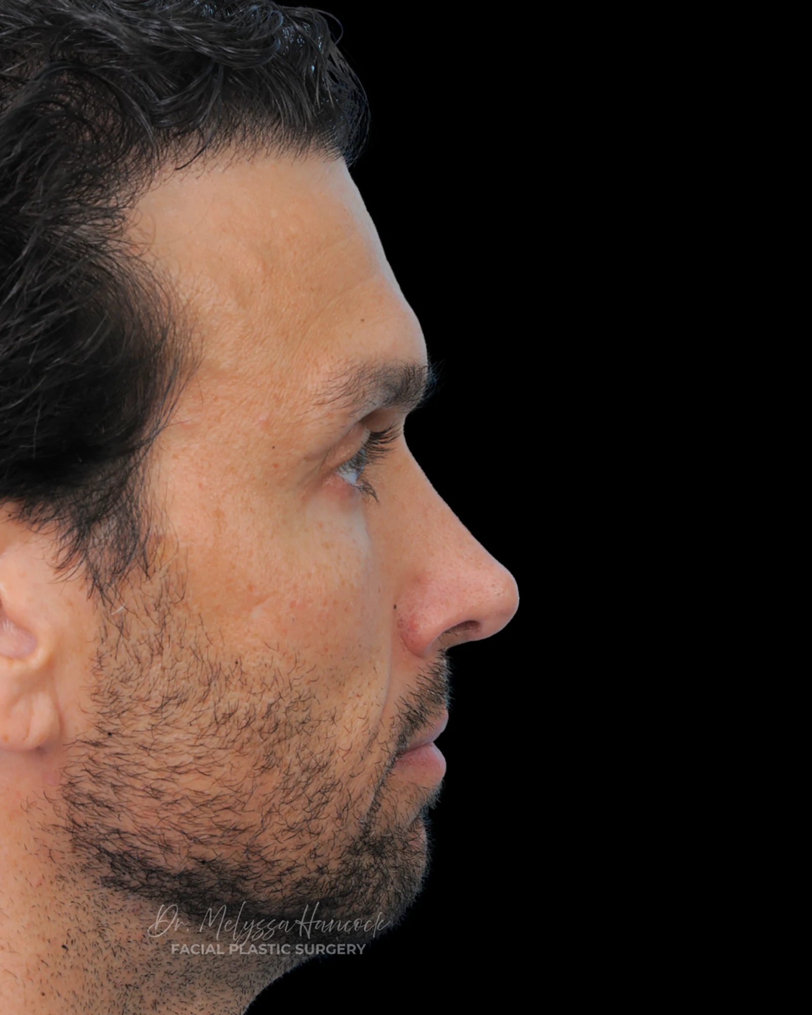 Photo of the patient’s after the Rhinoplasty Patient 31