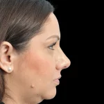 Thumbnail photo of the patient’s after the Rhinoplasty Patient 32