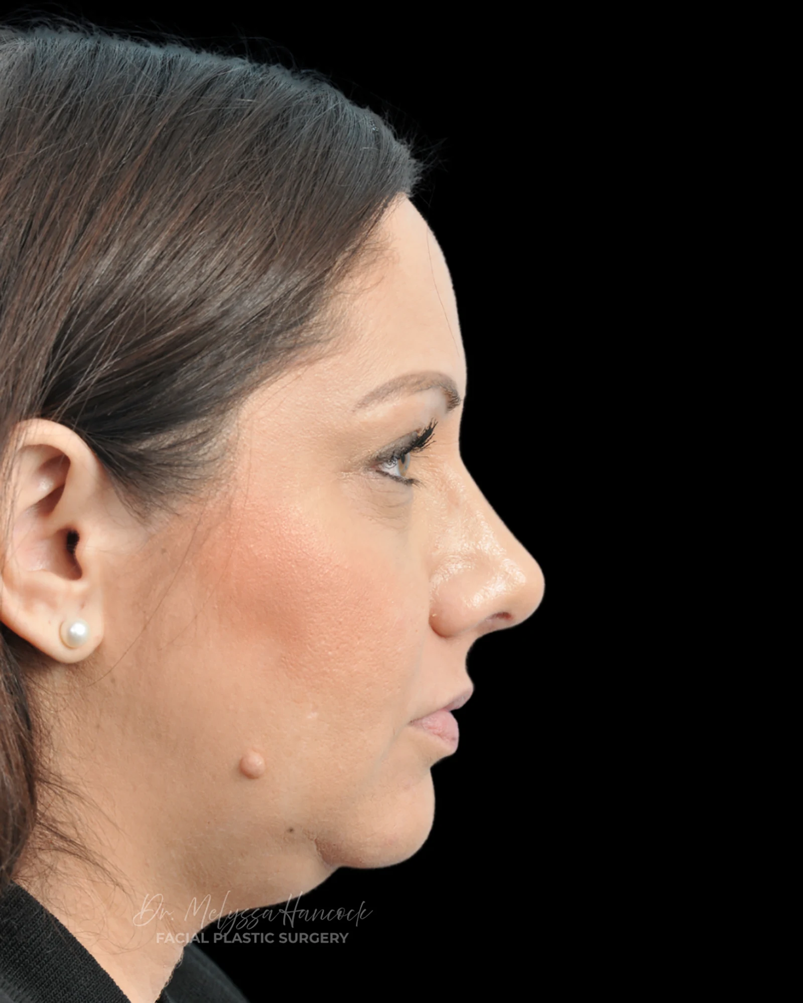 Photo of the patient’s after the Rhinoplasty Patient 32