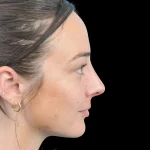 Thumbnail photo of the patient’s after the Rhinoplasty Patient 33