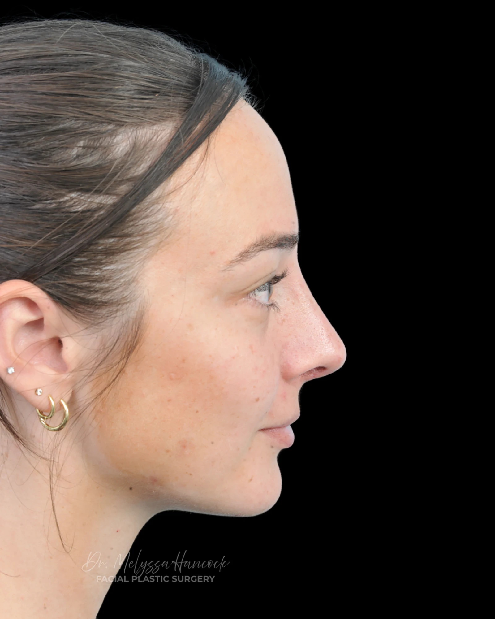 Photo of the patient’s after the Rhinoplasty Patient 33