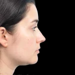 Thumbnail photo of the patient’s after the Rhinoplasty Patient 34