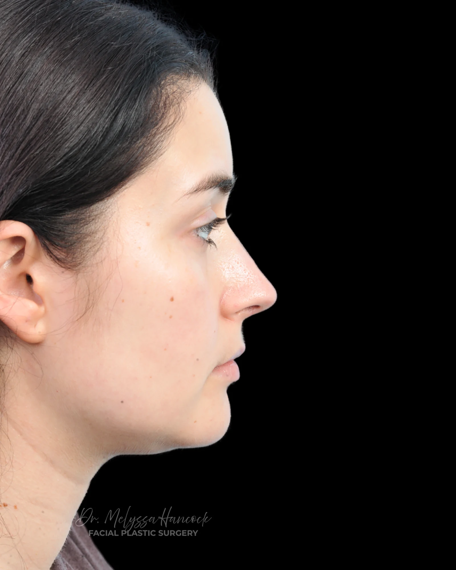 Photo of the patient’s after the Rhinoplasty Patient 34