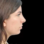 Thumbnail photo of the patient’s after the Rhinoplasty Patient 35