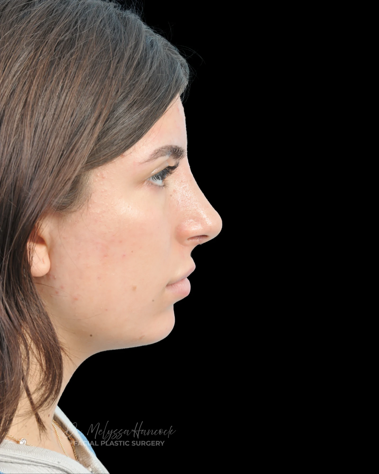 Photo of the patient’s after the Rhinoplasty Patient 35