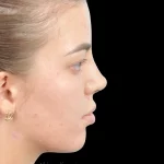 Thumbnail photo of the patient’s after the Rhinoplasty Patient 36