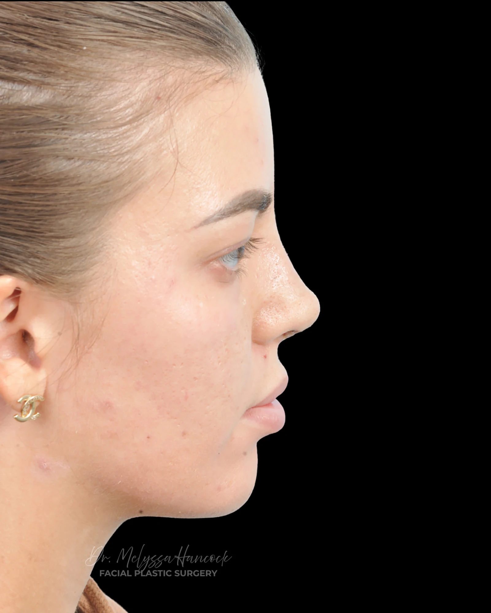 Photo of the patient’s after the Rhinoplasty Patient 36