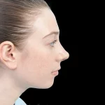 Thumbnail photo of the patient’s after the Rhinoplasty Patient 37