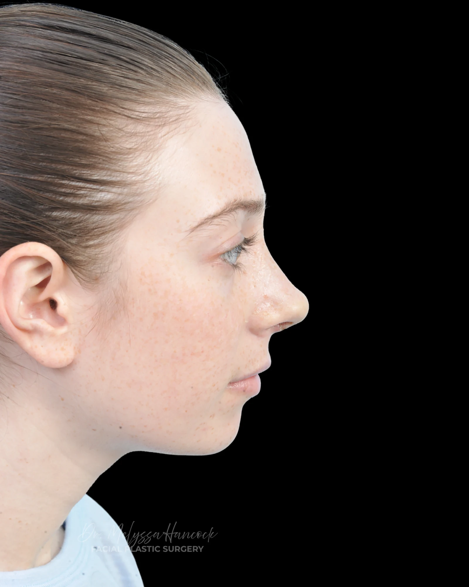 Photo of the patient’s after the Rhinoplasty Patient 37