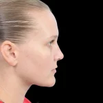 Thumbnail photo of the patient’s after the Rhinoplasty Patient 38
