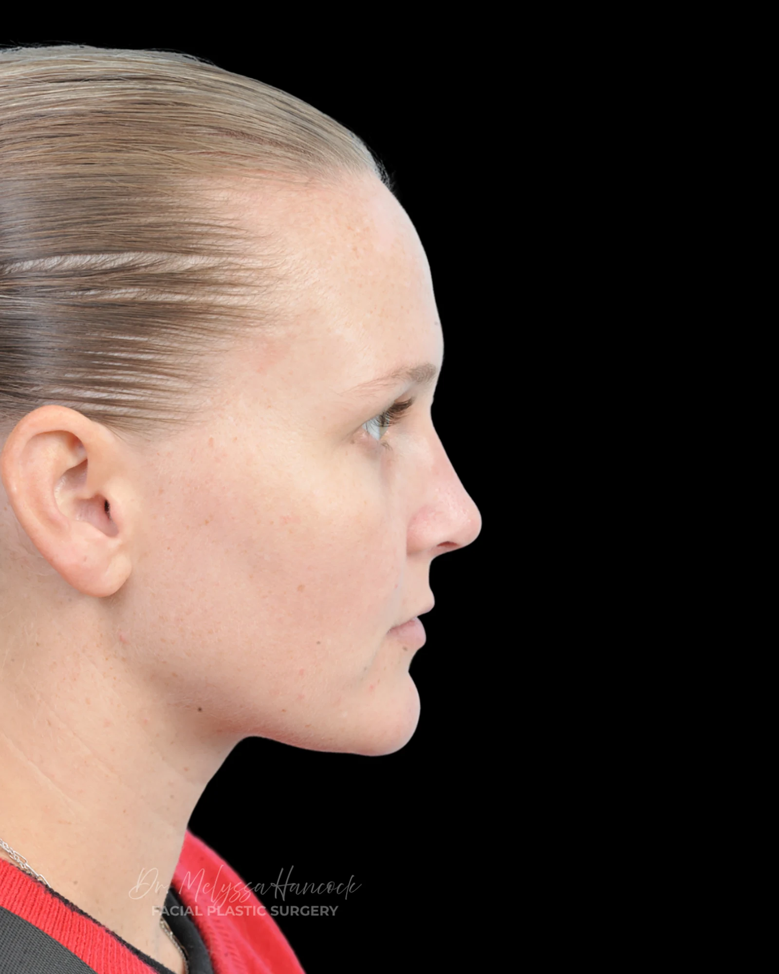Photo of the patient’s after the Rhinoplasty Patient 38