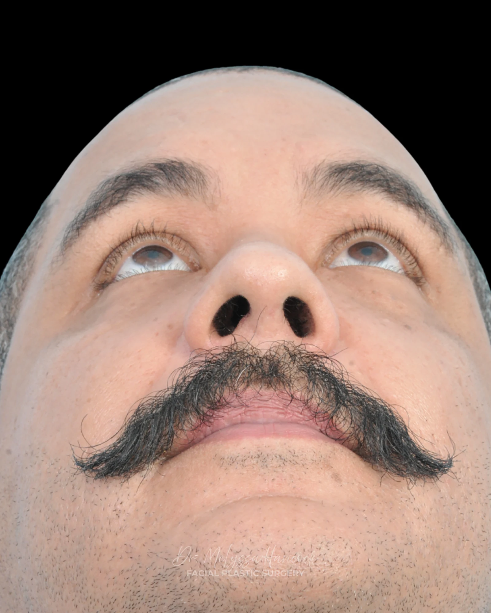 Photo of the patient’s after the Rhinoplasty Patient 27
