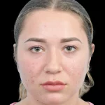 Thumbnail photo of the patient’s before the Rhinoplasty Patient 15