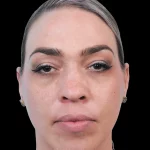 Thumbnail photo of the patient’s before the Rhinoplasty Patient 20