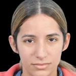 Thumbnail photo of the patient’s before the Rhinoplasty Patient 26