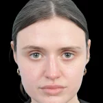Thumbnail photo of the patient’s before the Rhinoplasty Patient 30