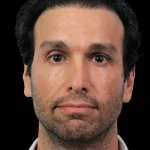 Thumbnail photo of the patient’s before the Rhinoplasty Patient 31