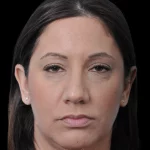 Thumbnail photo of the patient’s before the Rhinoplasty Patient 32