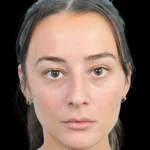 Thumbnail photo of the patient’s before the Rhinoplasty Patient 33