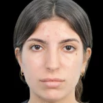 Thumbnail photo of the patient’s before the Rhinoplasty Patient 35